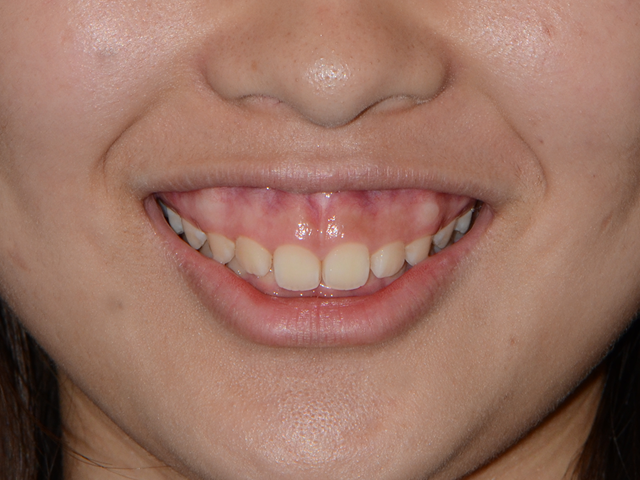 治療事例集 日本ガミースマイル研究会