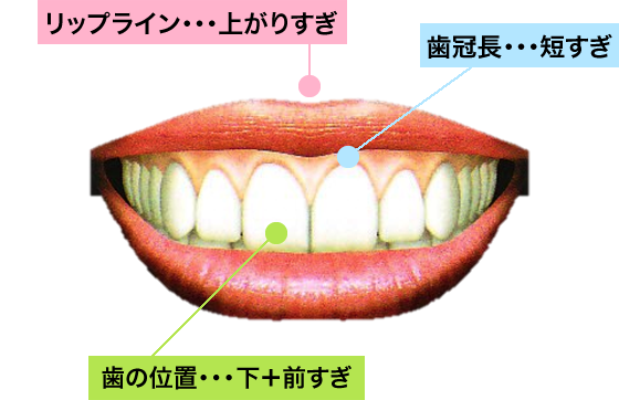 から が 見える 歯 歯茎 笑うと歯茎が出るガミースマイルの原因は？骨格？歯並び？上唇の筋肉？歯茎の粘膜？ ：